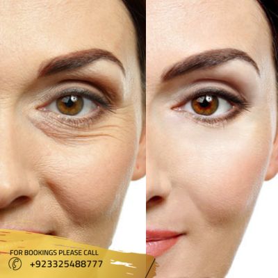 Results of Fine lines and wrinkles treatment in Islamabad