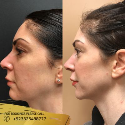 Results of Magic facelift in Islamabad