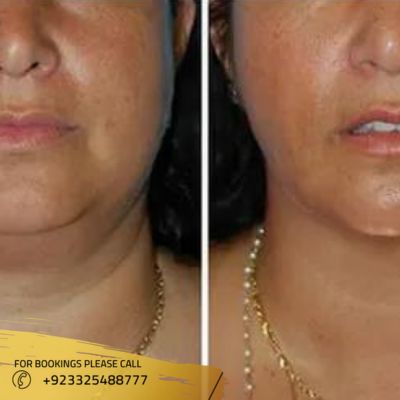 Results of buccal fat removal in islamabad