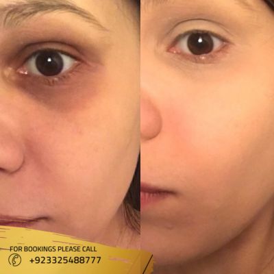 Results of dark circles treatment in Islamabad