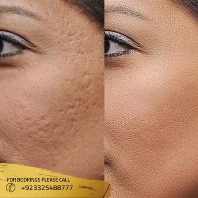 Results of large pores treatment in Islamabad