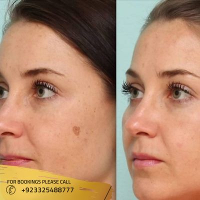 Results of laser mole removal treatment in Islamabad