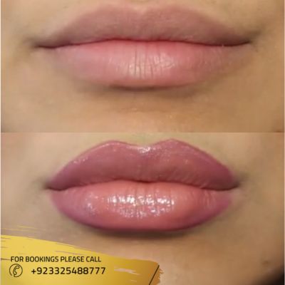 Results of lip filler in Islamabad
