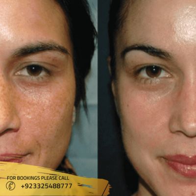 Results of melasma treatment in Islamabad
