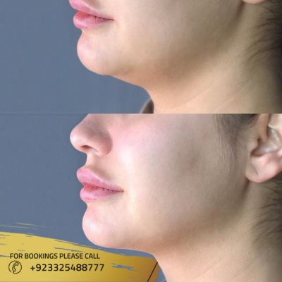 Before after of Double chin liposuction in Islamabad
