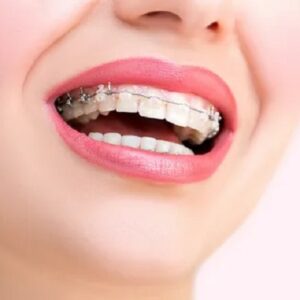 Dental Retainers VS Dental Braces in Islamabad