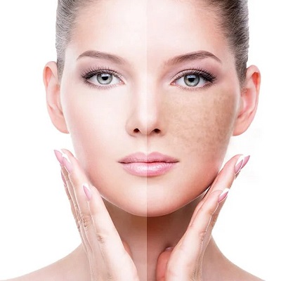 How To Maximize The Benefits Of Pigmentation Treatment in Islamabad?