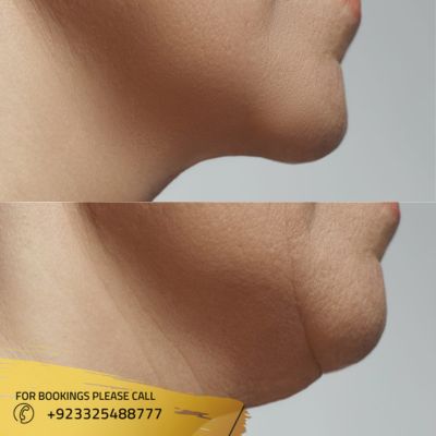 Images of double chin liposuction in Islamabad