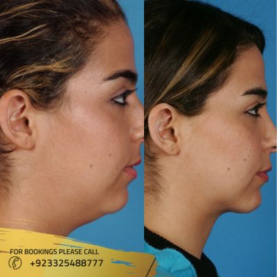 Images of neck lift in Islamabad