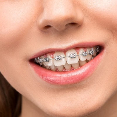 Will I need orthodontic treatment before my jaw surgery?