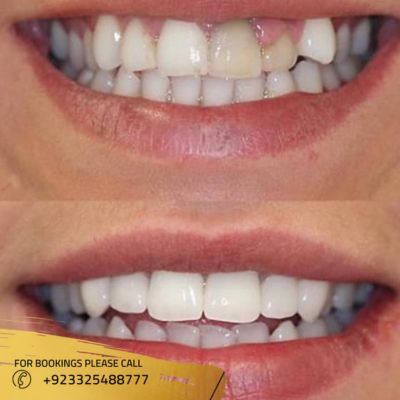 Before After of zirconia crown in Islamabad