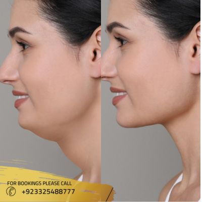 Before after of face fat transfer in Islamabad