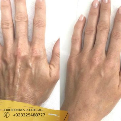 Before after of hand rejuvenation in Islamabad