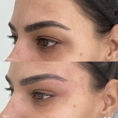 Can A Brow Lift in Islamabad Look Natural?