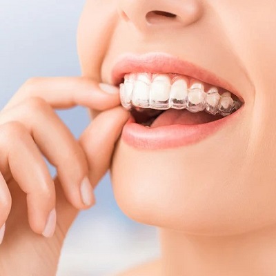 Dental Retainers Cost in Islamabad