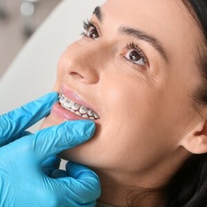 Dental braces Cost in Islamabad