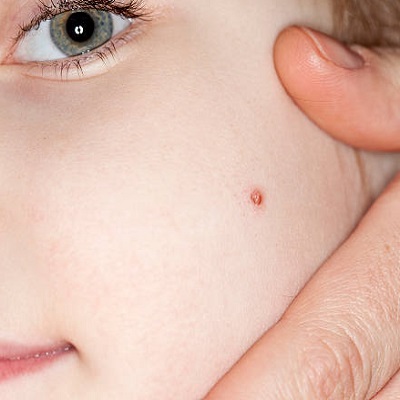 How Do Dermatologists Remove Warts in Islamabad