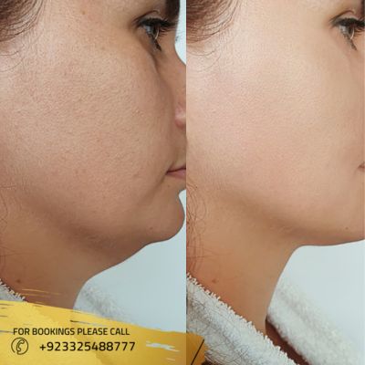 Images of face fat transfer in Islamabad