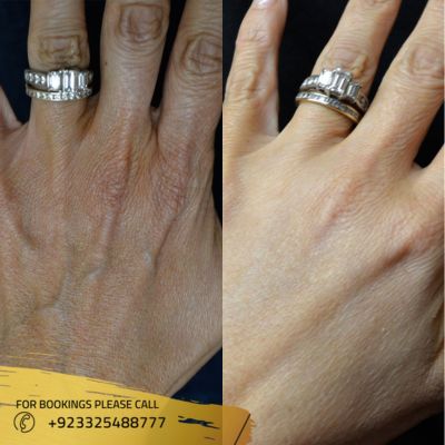 Images of hand rejuvenation in Islamabad