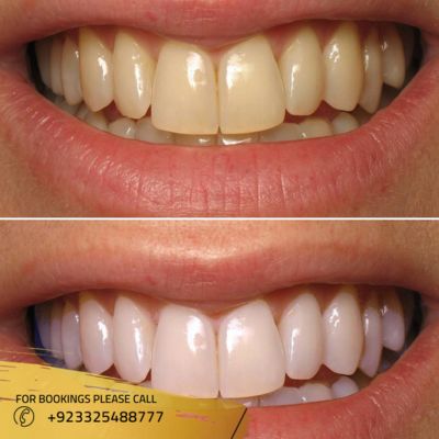 Images of zirconia crown in Islamabad