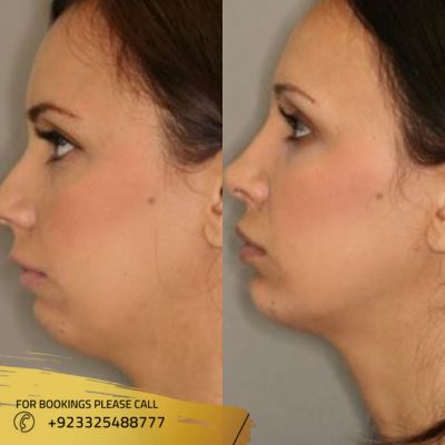 Results of face fat transfer in Islamabad
