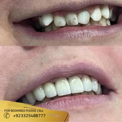 Results of zirconia crown in Islamabad