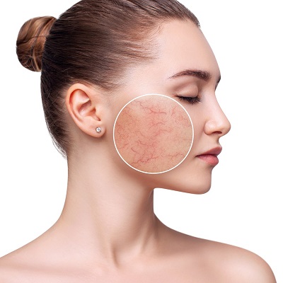 What Is the Most Effective Treatment for Rosacea?