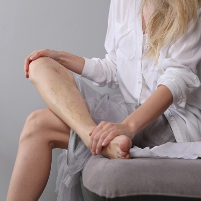What Is the Most Effective Treatment for Spider Veins?