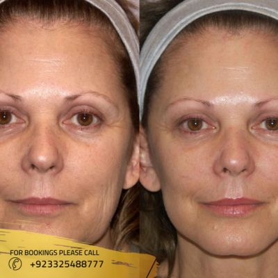 before after of facelift treatment in Islamabad