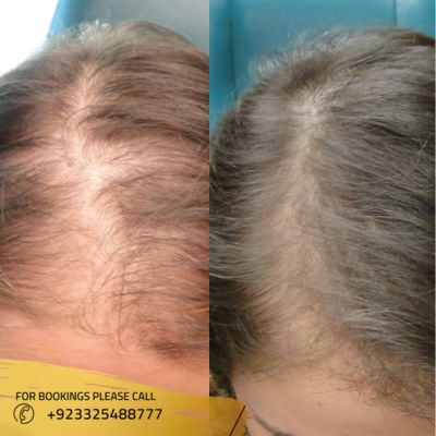 before after of hair loss treatment in Islamabad