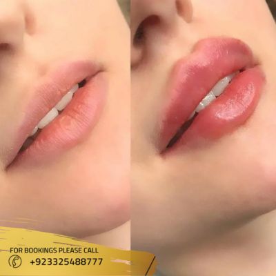 before after of lip augmentation in Islamabad