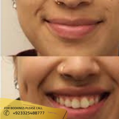images of dimple creation in Islamabad