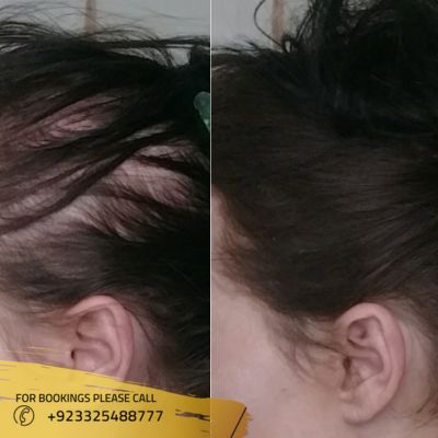 images of hair loss treatment in Islamabad