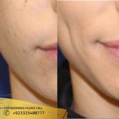 results of dimple creation in Islamabad