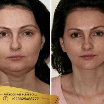 results of facelift treatment in Islamabad