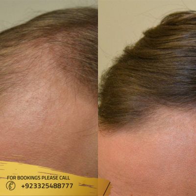 results of hair loss treatment in Islamabad