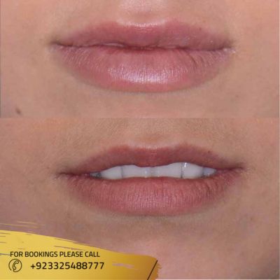 results of lip augmentation in Islamabad