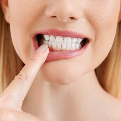 How I cured my gum recession in Islamabad?