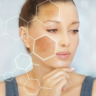 How to Stop Melasma from Spreading?
