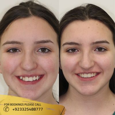 before after of dental braces in Islamabad