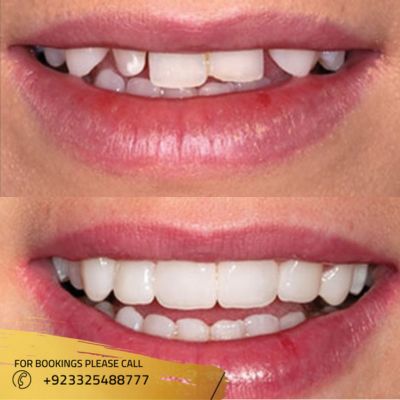 before after of dental crown in Islamabad