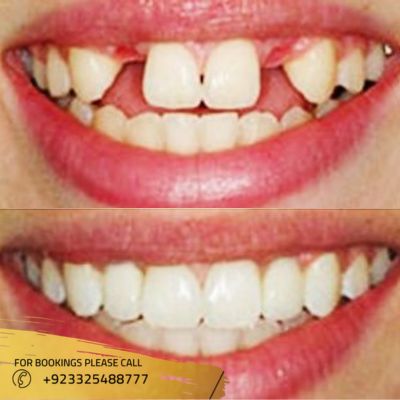 before after of dental implant in Islamabad (1)