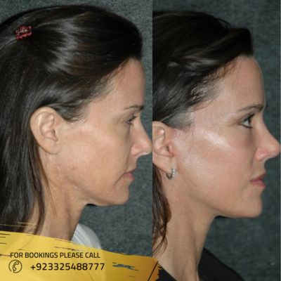 before after of facelift treatment in Islamabad (1)