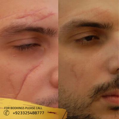 before after of laser scar removal in Islamabad