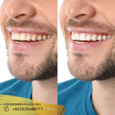 before after of laser teeth whitening in Islamabad