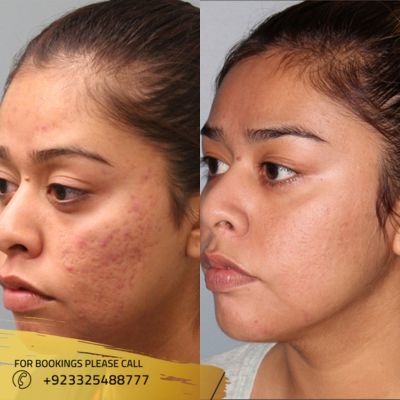 before after of microdermabrasion treatment in Islamabad