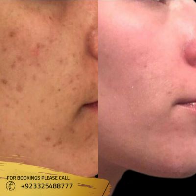 before after of microneedling treatment in Islamabad