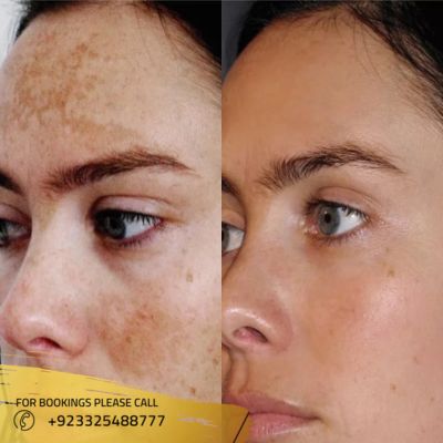 before after of pigmentation treatment in Islamabad