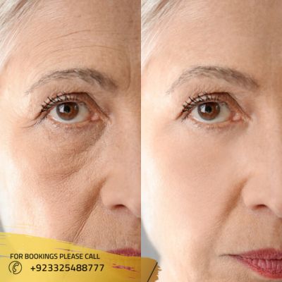 before after of skin rejuvenation in Islamabad