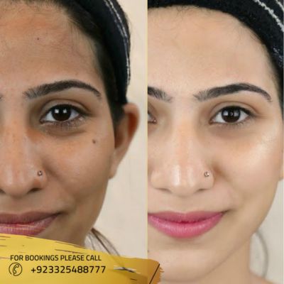before after of skin whitening treatment in Islamabad